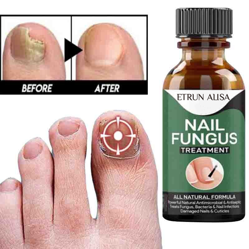 Nail Fungus Solution