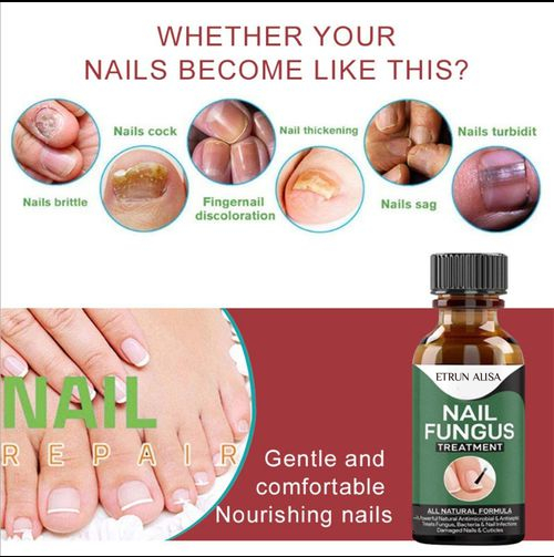 Nail Fungus Solution